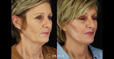 Facelift Before & After Gallery - Patient 329831 - Image 1