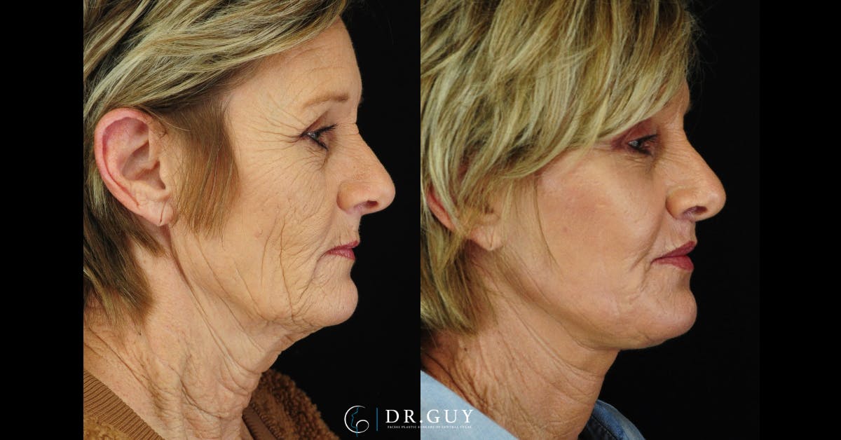 Facelift Before & After Gallery - Patient 329831 - Image 5