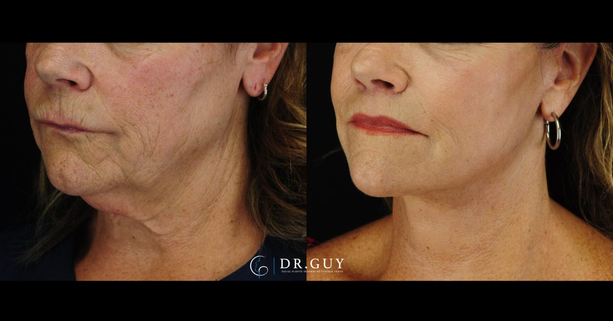Facelift Before & After Gallery - Patient 224757 - Image 1