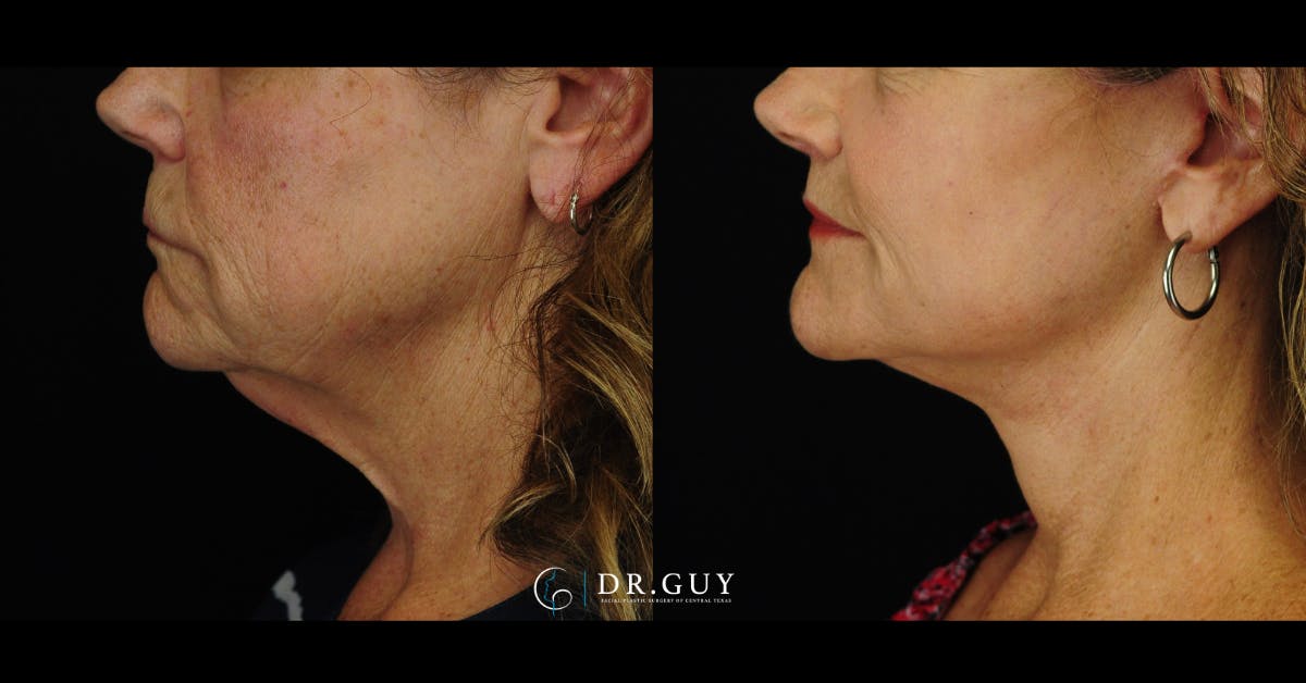 Facelift Before & After Gallery - Patient 224757 - Image 2