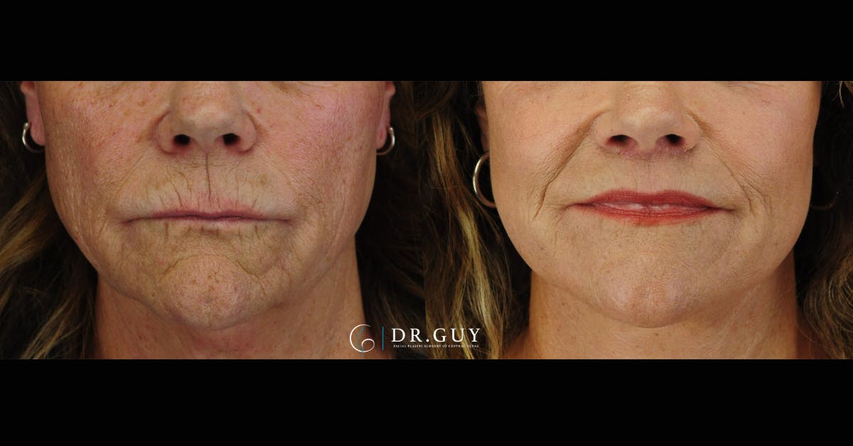 Facelift Before & After Gallery - Patient 224757 - Image 3