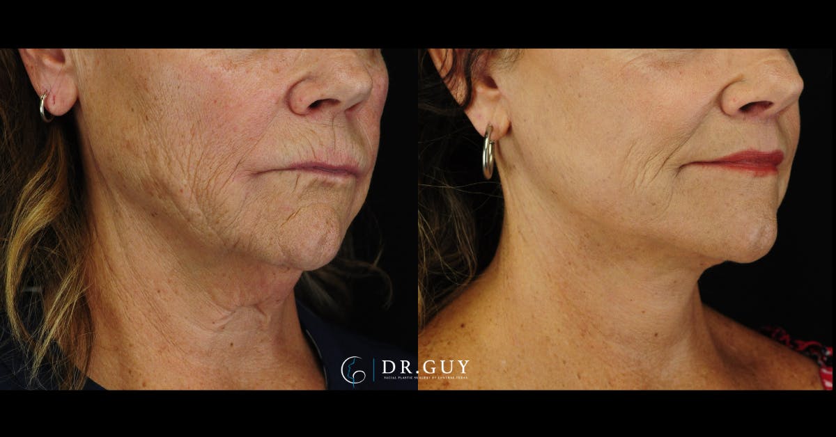 Facelift Before & After Gallery - Patient 224757 - Image 4