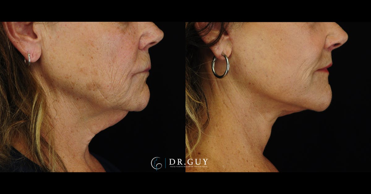 Facelift Before & After Gallery - Patient 224757 - Image 5