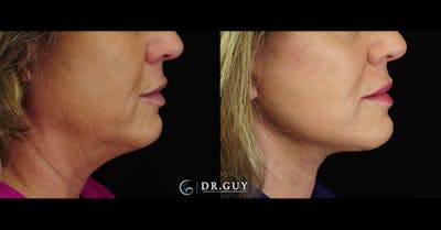 Facelift Before & After Gallery - Patient 416348 - Image 1