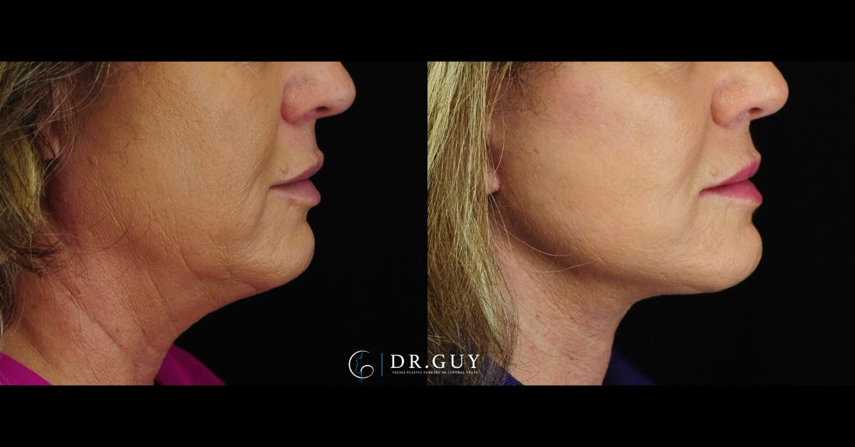 Facelift Before & After Gallery - Patient 416348 - Image 1