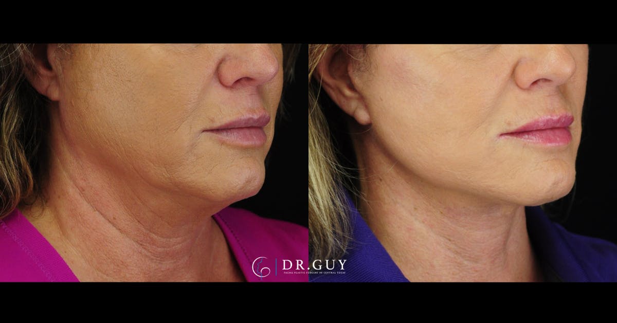 Facelift Before & After Gallery - Patient 416348 - Image 2
