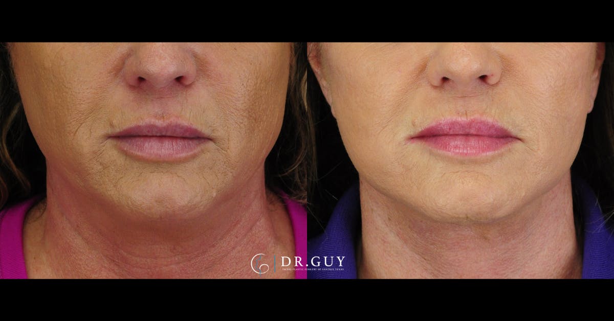 Facelift Before & After Gallery - Patient 416348 - Image 3