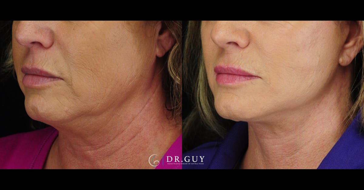 Facelift Before & After Gallery - Patient 416348 - Image 4