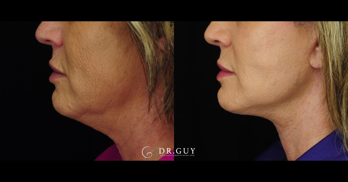 Facelift Before & After Gallery - Patient 416348 - Image 5