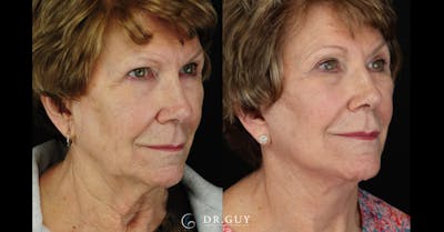 Facelift Before & After Gallery - Patient 245728 - Image 1