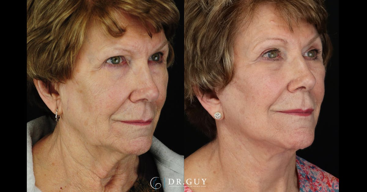Facelift Before & After Gallery - Patient 245728 - Image 1