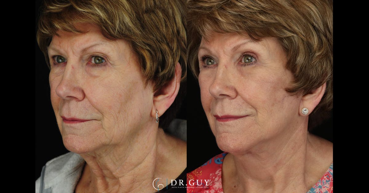 Facelift Before & After Gallery - Patient 245728 - Image 2