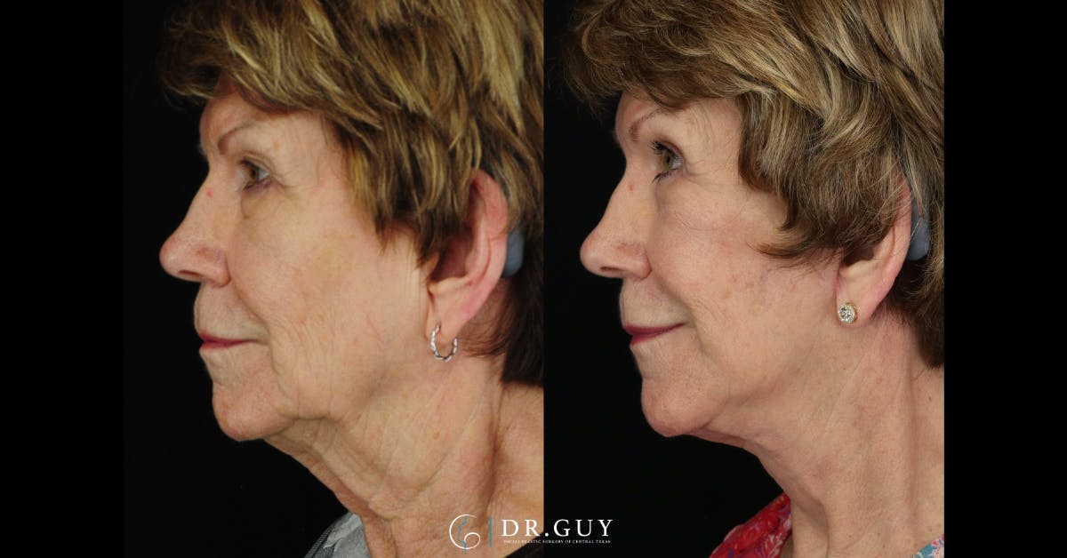 Facelift Before & After Gallery - Patient 245728 - Image 3