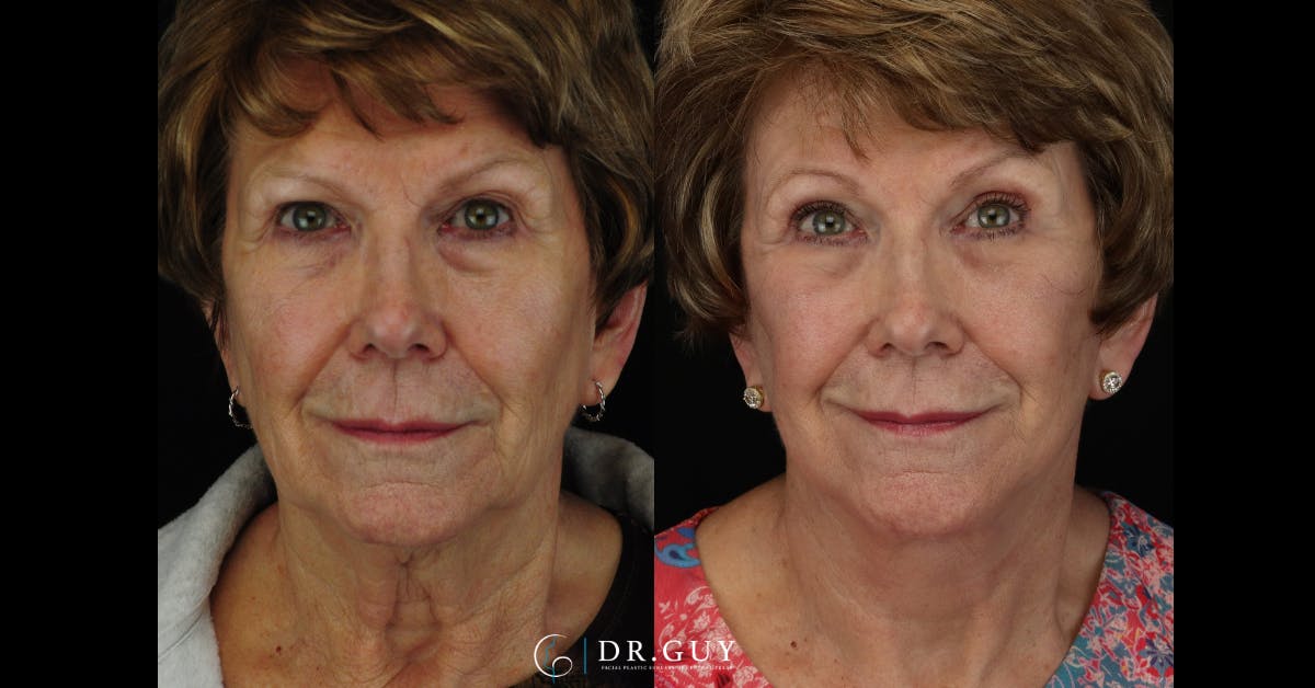 Facelift Before & After Gallery - Patient 245728 - Image 4