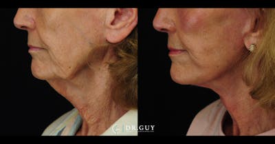 Facelift Before & After Gallery - Patient 241791 - Image 1