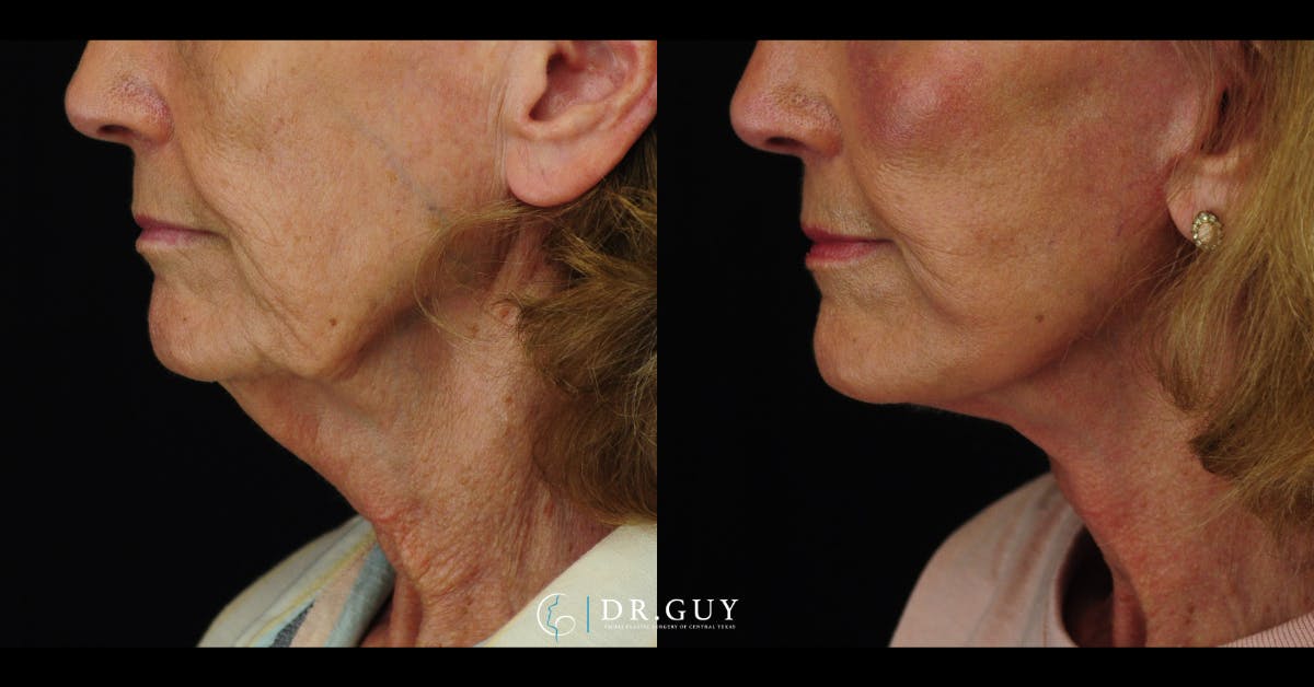 Facelift Before & After Gallery - Patient 241791 - Image 1