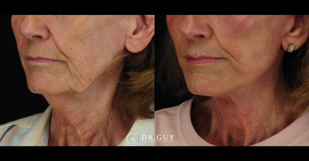 Facelift Before & After Gallery - Patient 241791 - Image 2