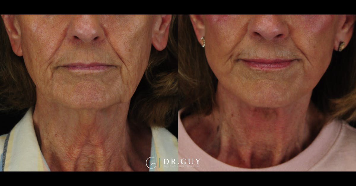 Facelift Before & After Gallery - Patient 241791 - Image 3