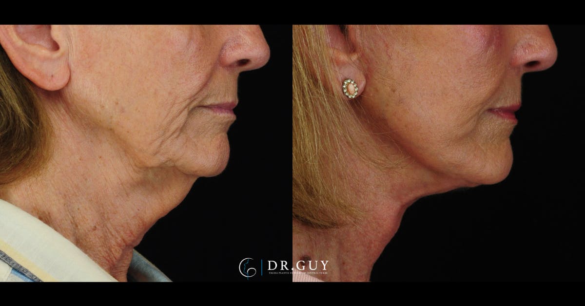 Facelift Before & After Gallery - Patient 241791 - Image 4