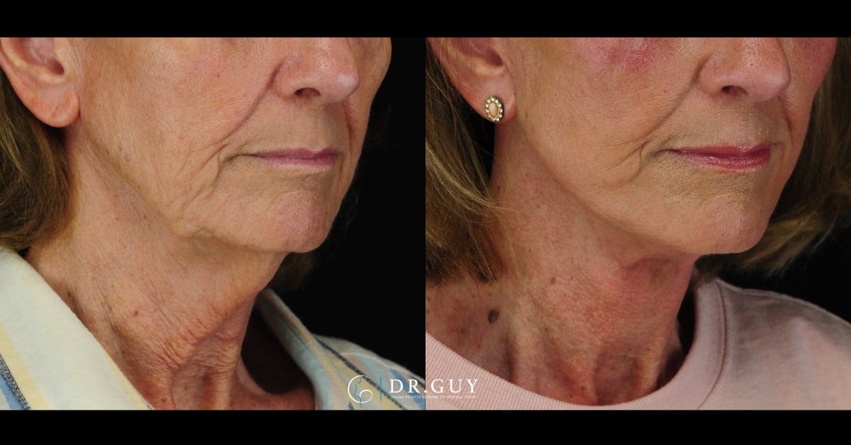 Facelift Before & After Gallery - Patient 241791 - Image 5