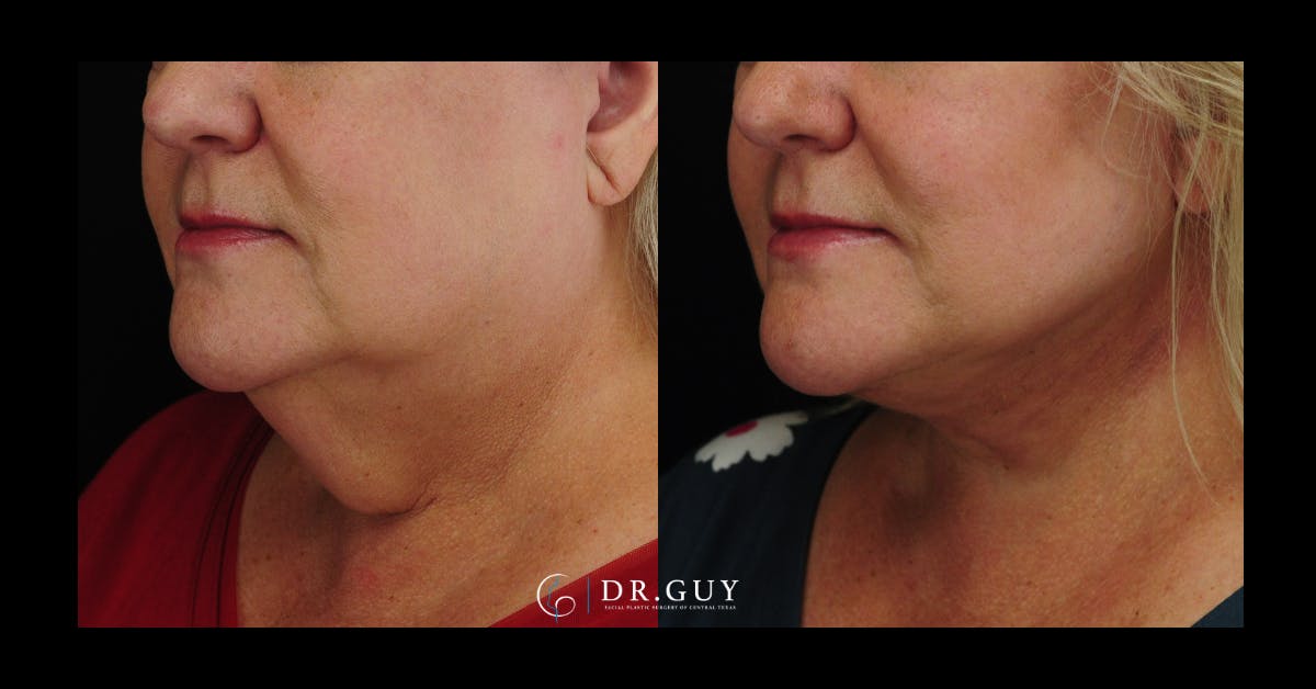 Facelift Before & After Gallery - Patient 324707 - Image 1