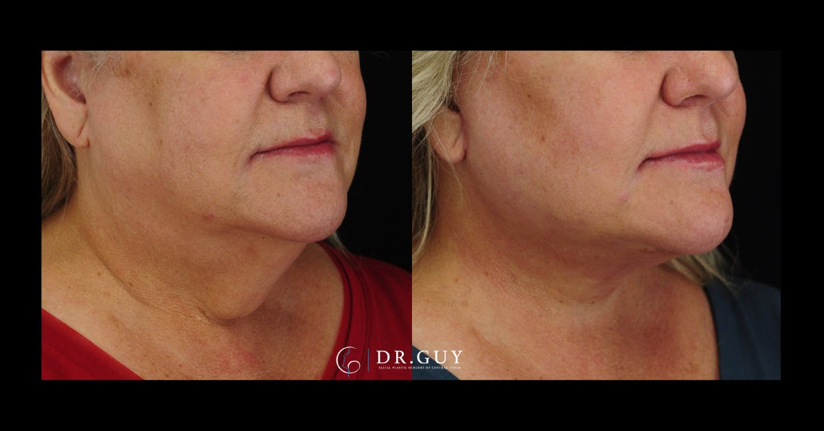 Facelift Before & After Gallery - Patient 324707 - Image 2