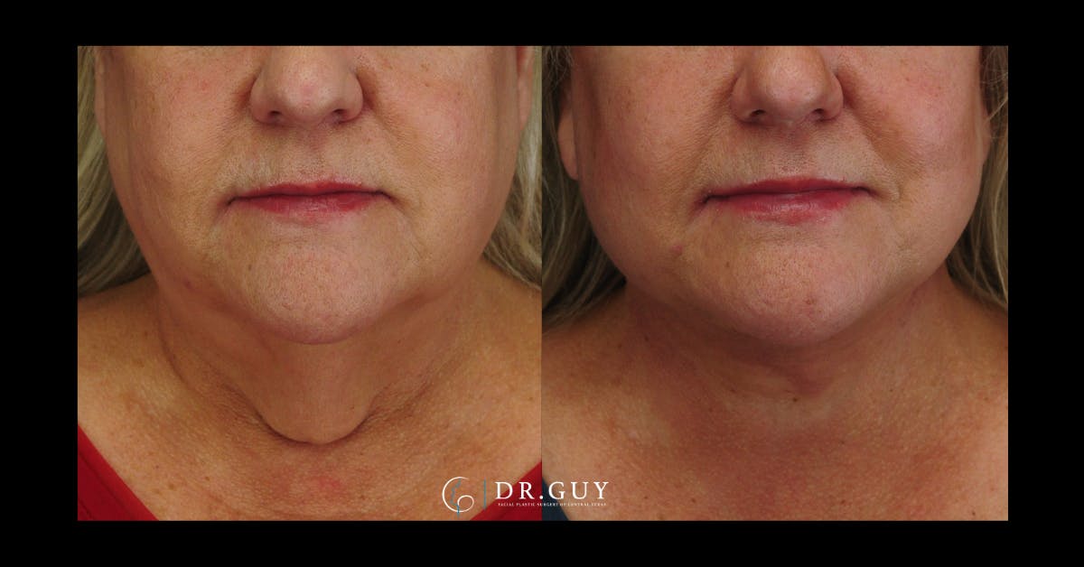 Facelift Before & After Gallery - Patient 324707 - Image 3