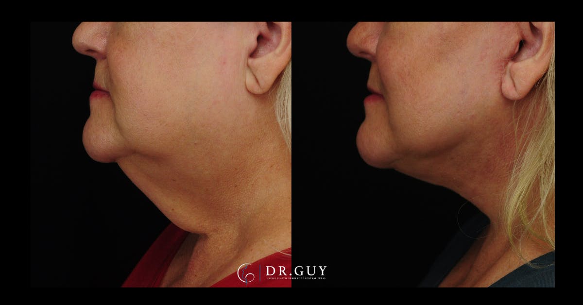 Facelift Before & After Gallery - Patient 324707 - Image 4
