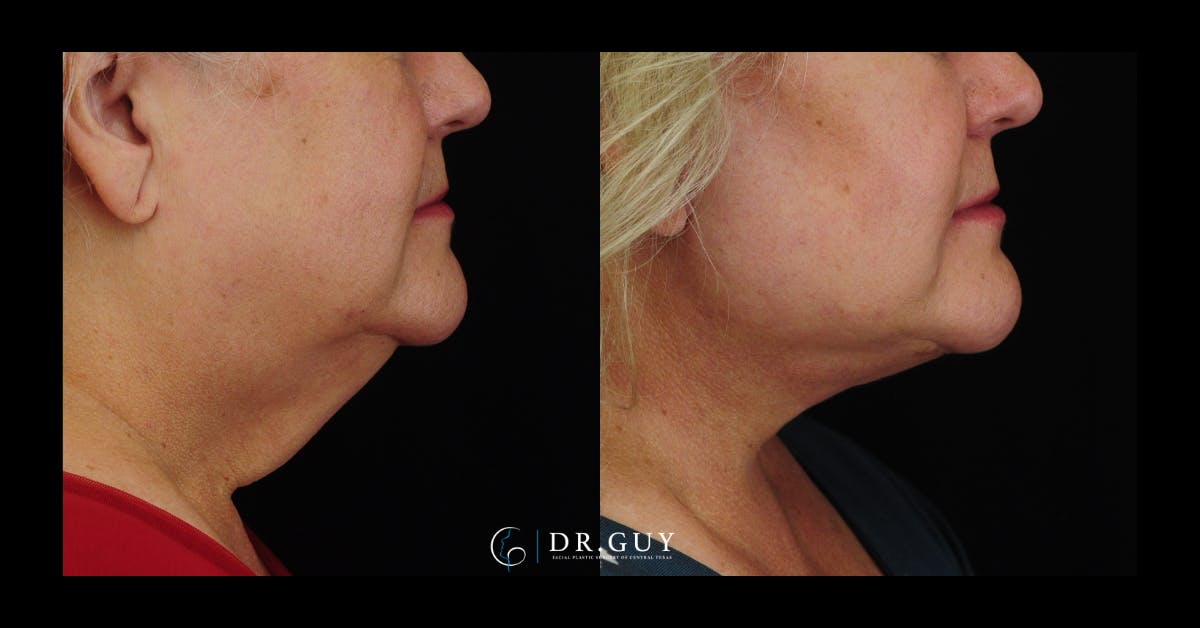 Facelift Before & After Gallery - Patient 324707 - Image 5
