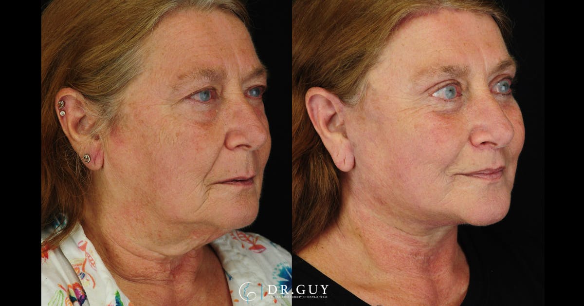 Facelift Before & After Gallery - Patient 186393 - Image 1