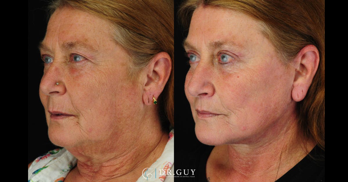 Facelift Before & After Gallery - Patient 186393 - Image 3