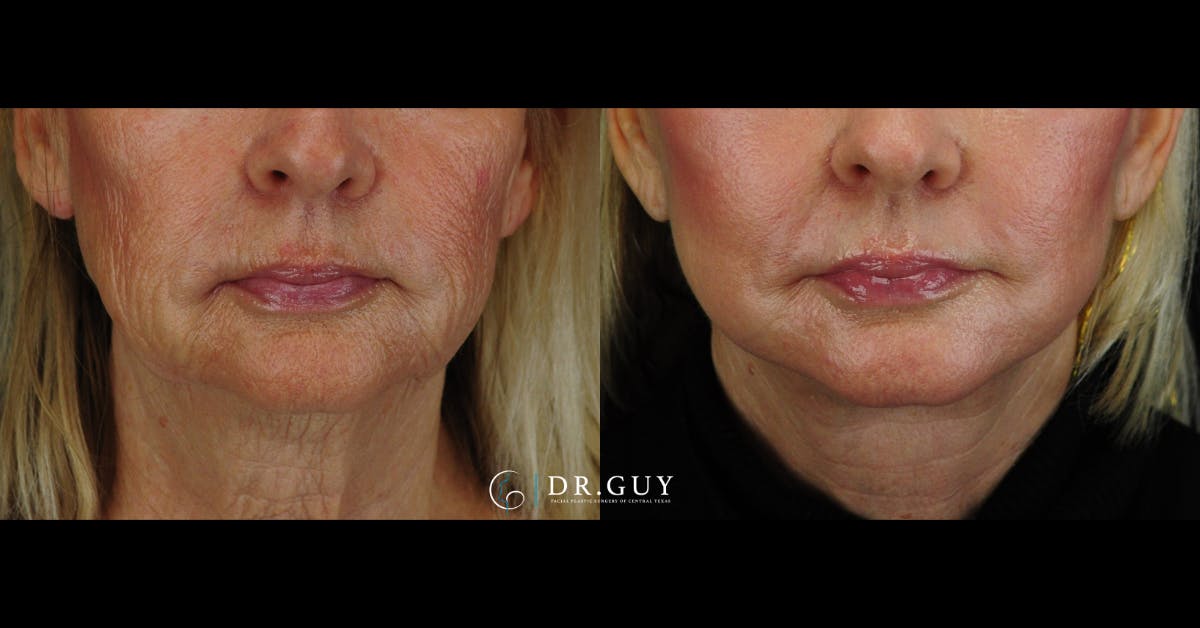 Facelift Before & After Gallery - Patient 988465 - Image 3