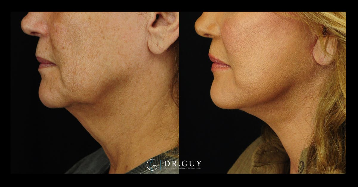 Facelift Before & After Gallery - Patient 104765 - Image 2