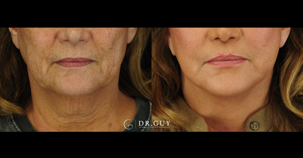 Facelift Before & After Gallery - Patient 104765 - Image 3