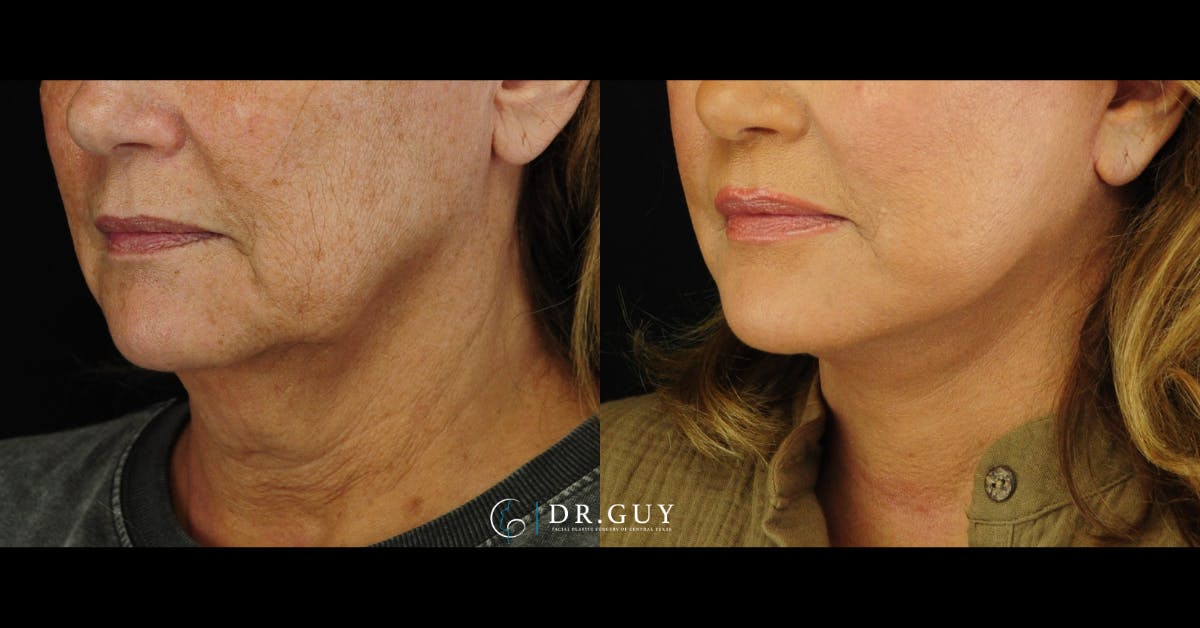 Facelift Before & After Gallery - Patient 104765 - Image 4