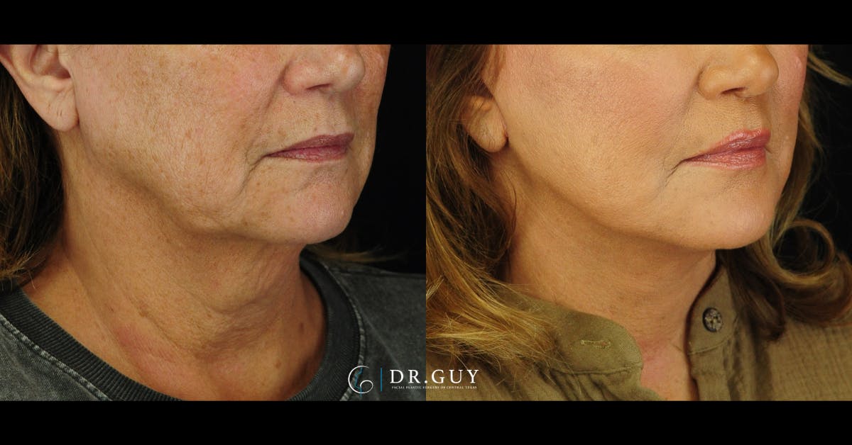 Facelift Before & After Gallery - Patient 104765 - Image 5