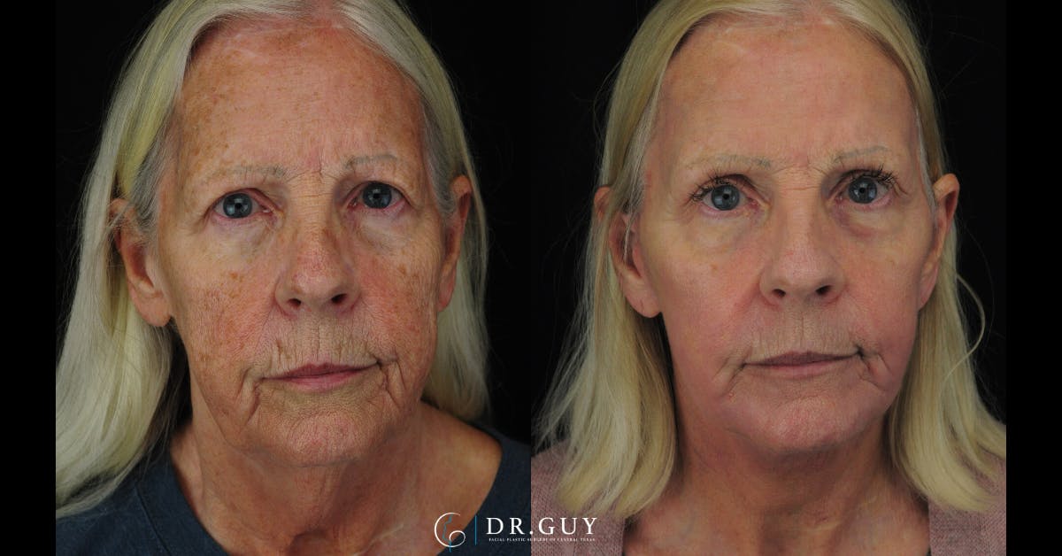 Facelift Before & After Gallery - Patient 223984 - Image 1