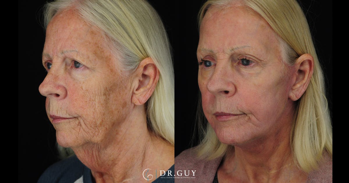 Facelift Before & After Gallery - Patient 223984 - Image 2