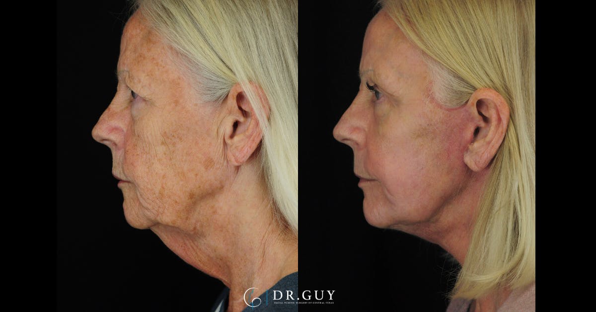 Facelift Before & After Gallery - Patient 223984 - Image 3