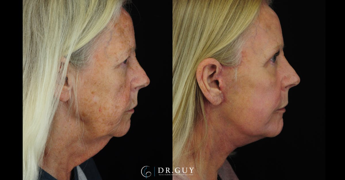 Facelift Before & After Gallery - Patient 223984 - Image 5