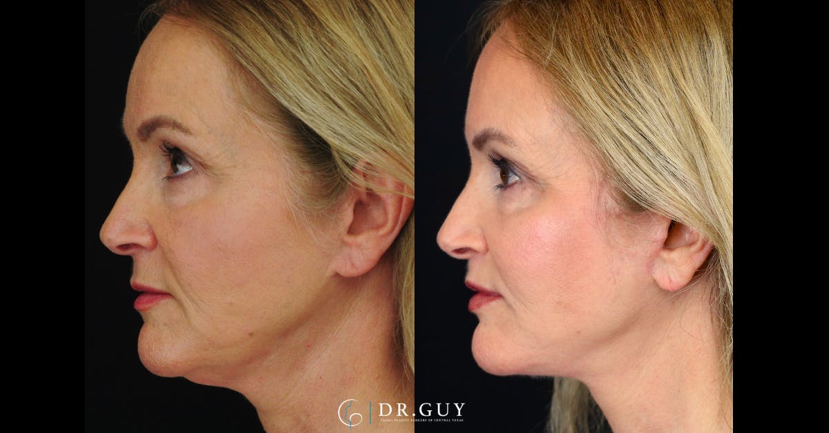 Facelift Before & After Gallery - Patient 364565 - Image 1