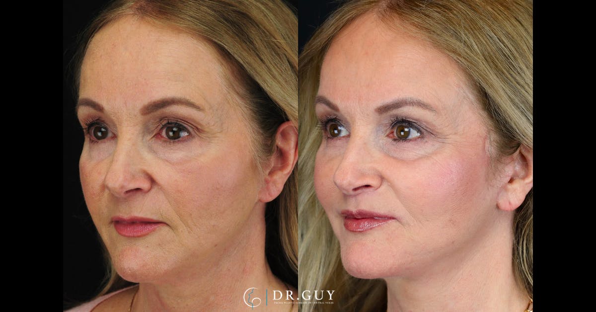Facelift Before & After Gallery - Patient 364565 - Image 2