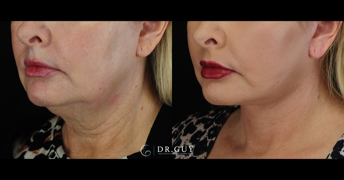 Facelift Before & After Gallery - Patient 352844 - Image 1