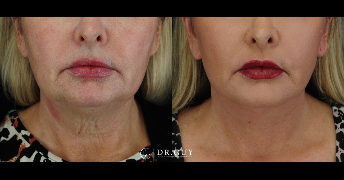 Facelift Before & After Gallery - Patient 352844 - Image 2