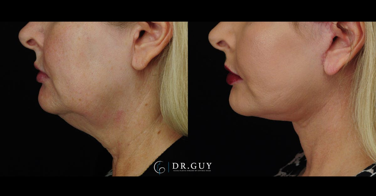 Facelift Before & After Gallery - Patient 352844 - Image 3