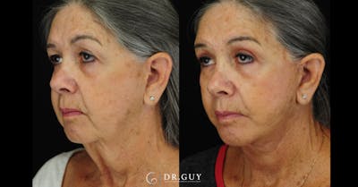 Facelift Before & After Gallery - Patient 383738 - Image 1