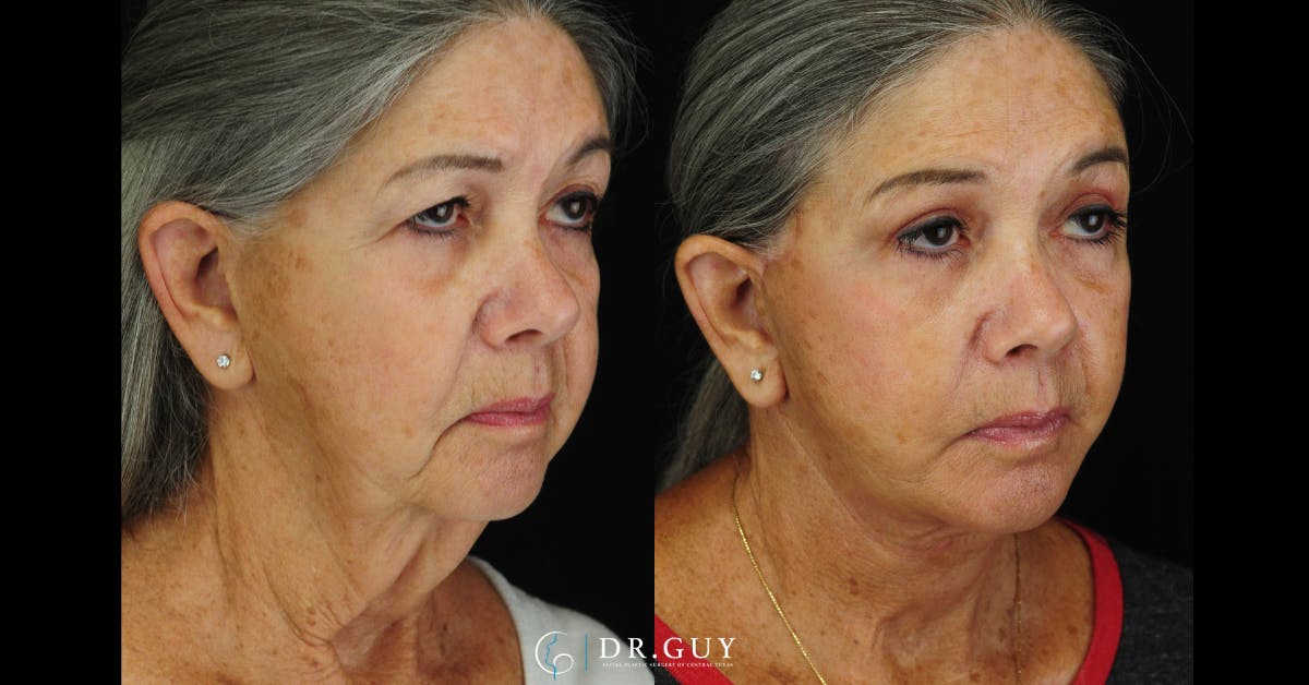 Facelift Before & After Gallery - Patient 383738 - Image 2