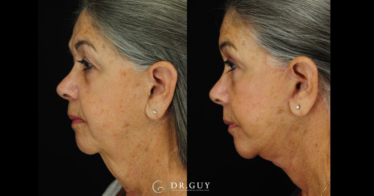 Facelift Before & After Gallery - Patient 383738 - Image 4