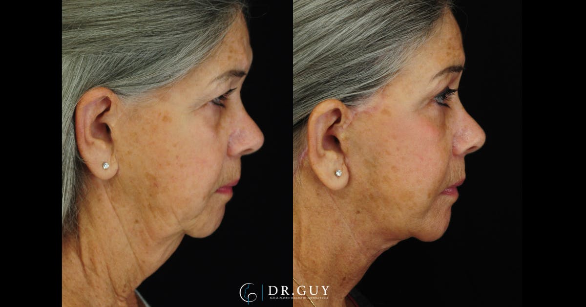 Facelift Before & After Gallery - Patient 383738 - Image 5