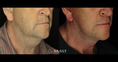 Facelift Before & After Gallery - Patient 303016 - Image 1